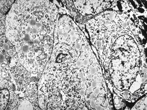 M,58y. | carcinoma gl. parotis M,58y. | carcinoma gl. parotis